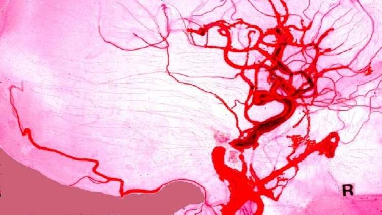 أمراض الأوعية الدموية تؤثر سلبا في بنية الدماغ